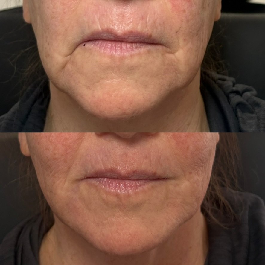 Filler around mouth and jawline