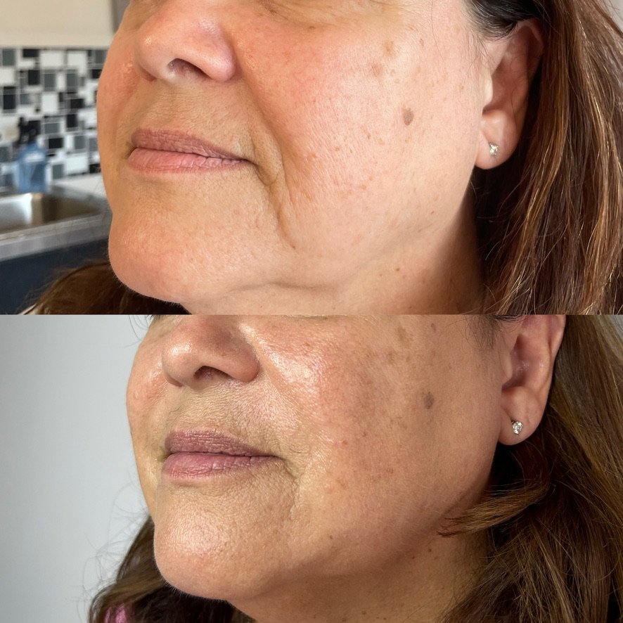 Multi-syringe treatment in lower and mid face
