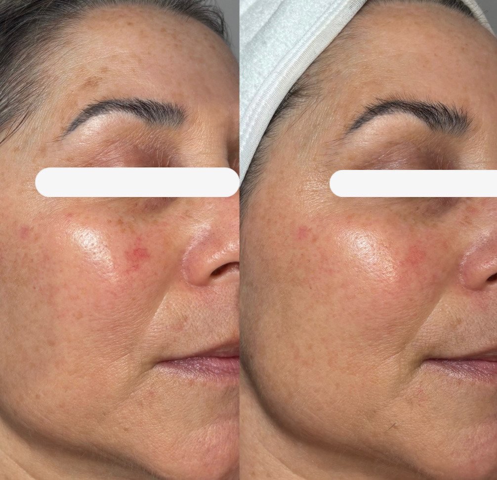 Custom Laser Facial for Dark Spots, Redness, 1 treatment
