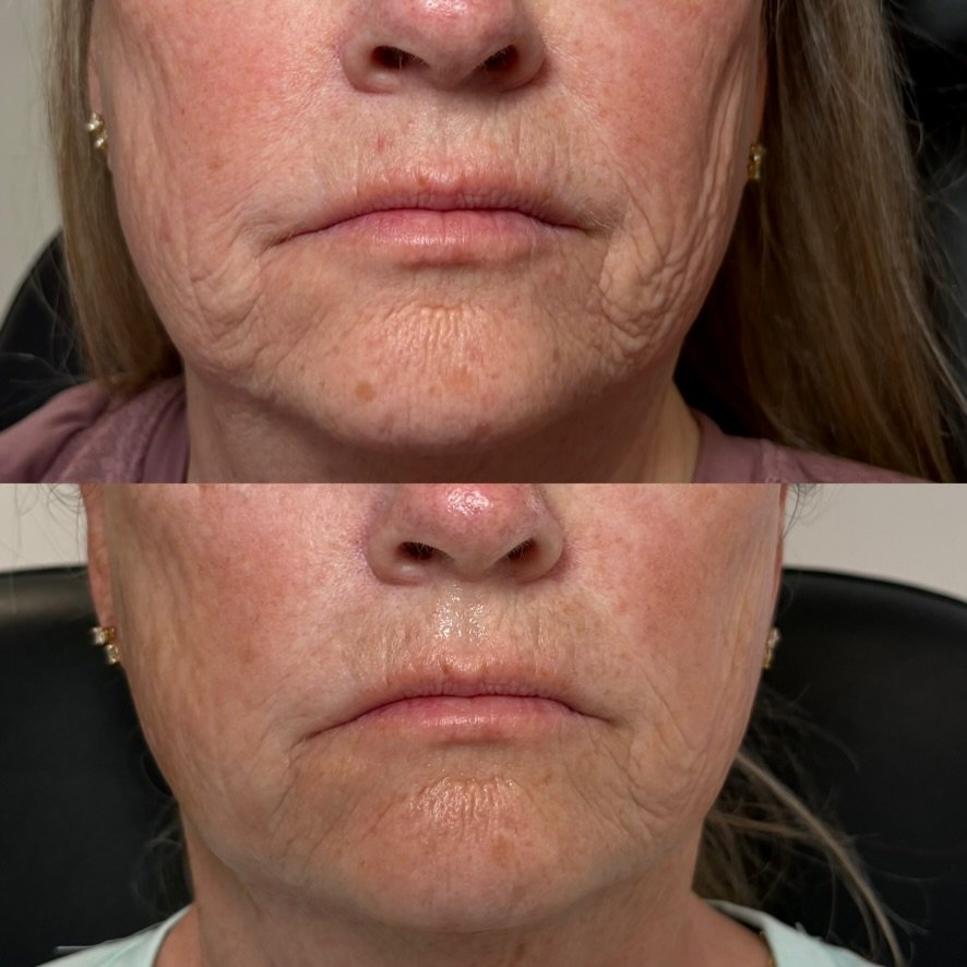 Deep fractional resurfacing — firming and fine lines