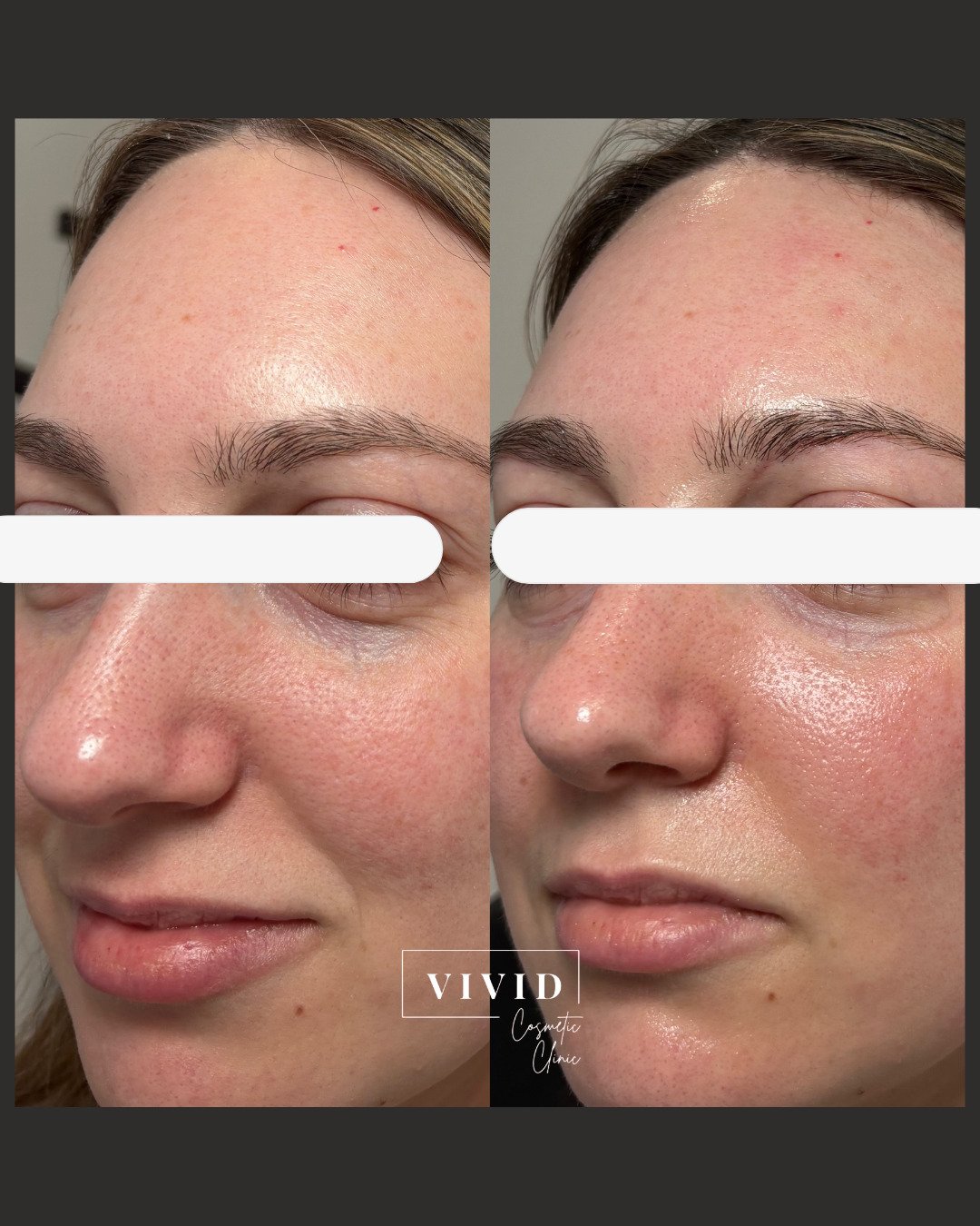 Naturapeel Hollywood facial — pores and brightening