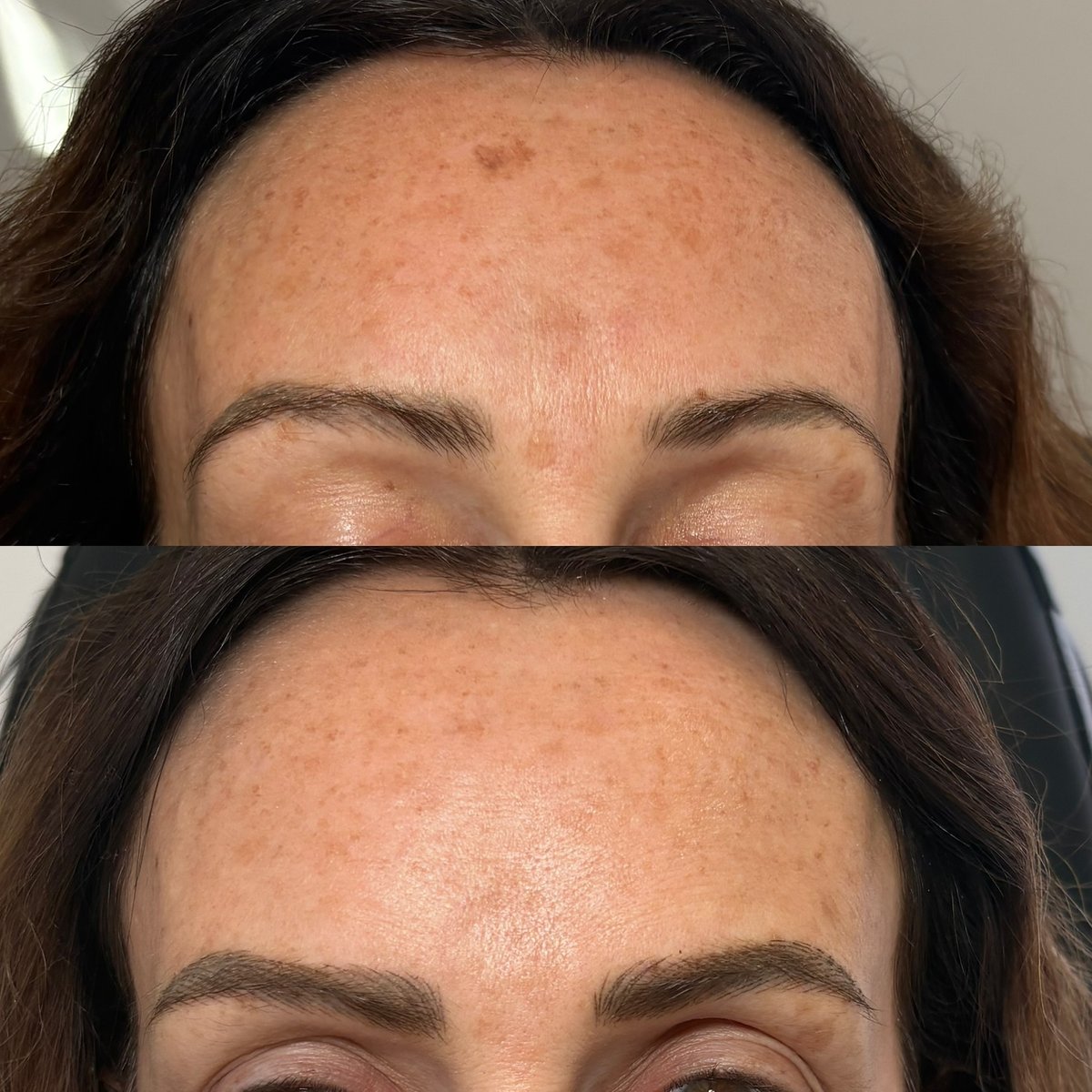 Custom Laser Facial for Sun Spots, 2 treatments