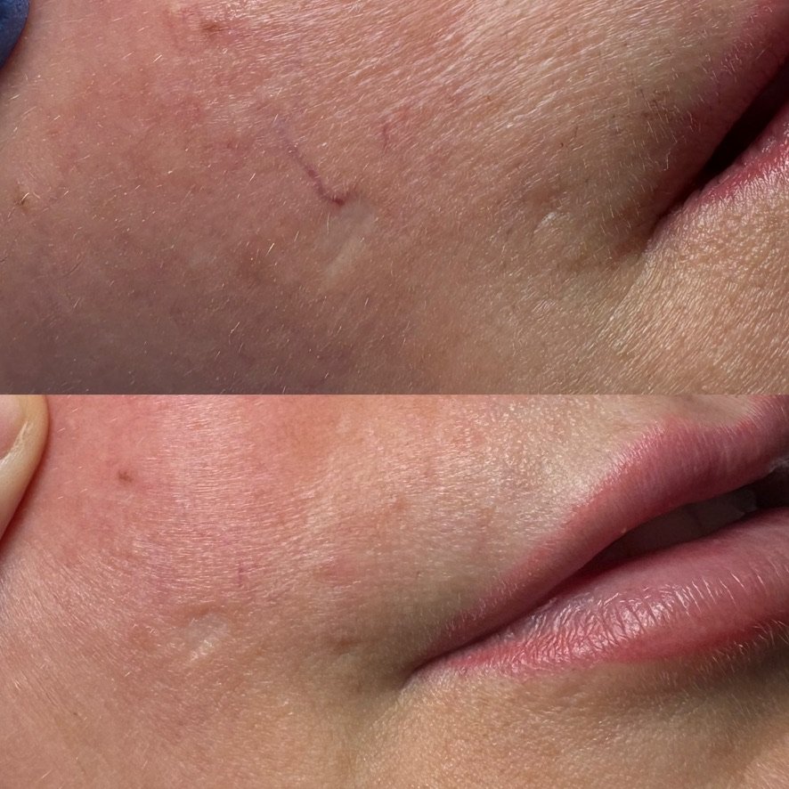 Laser vein treatment, 1 treatment