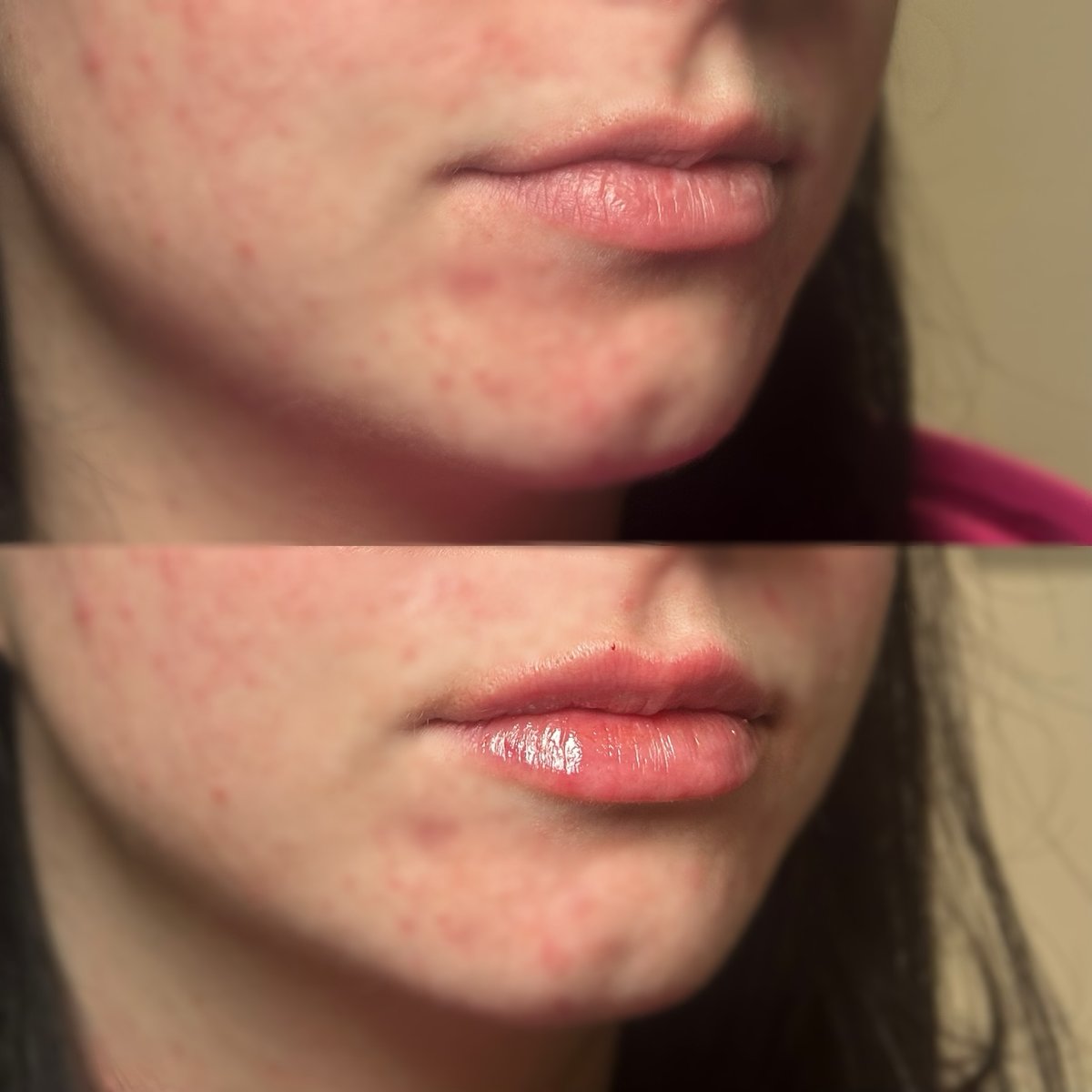 Lip filler — 0.7 syringe, M shape correction