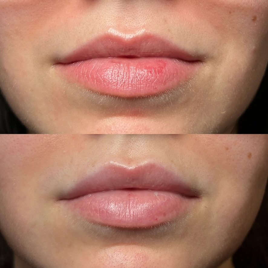 Lip filler — Before and 1.5 year after last injection