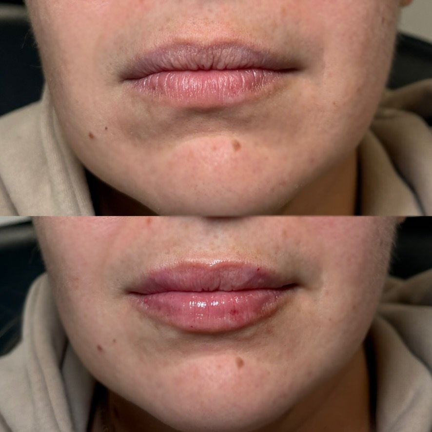 Lip filler — 0.5 syringe, natural plump