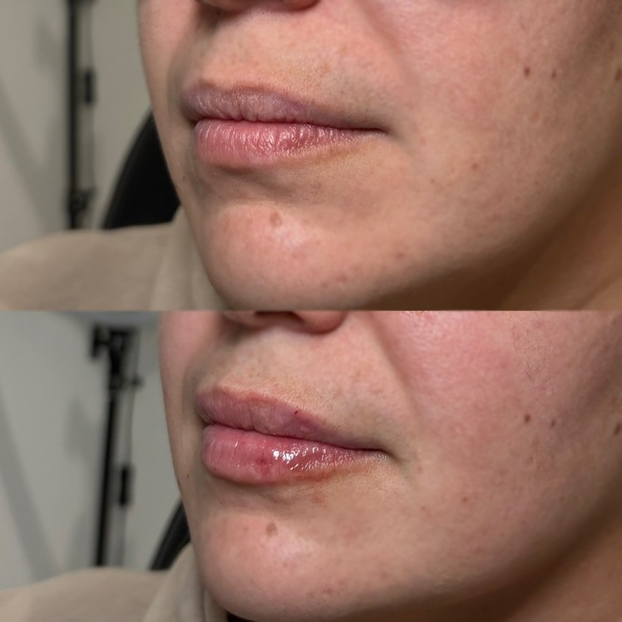 Lip filler — restoration and hydration