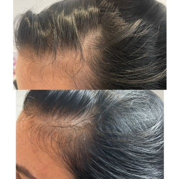 PRP hair restoration, 1 session