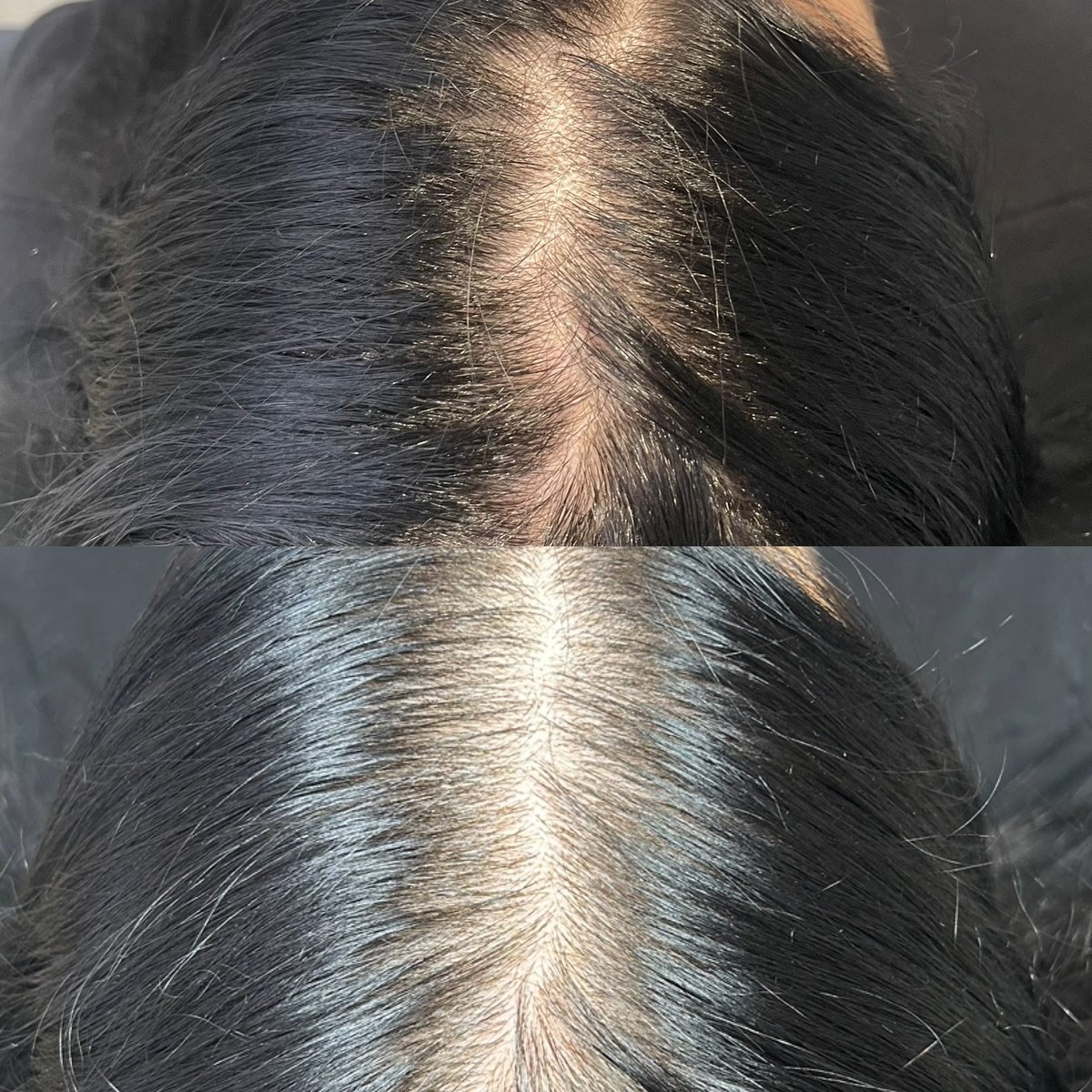 PRP hair restoration, 1 session