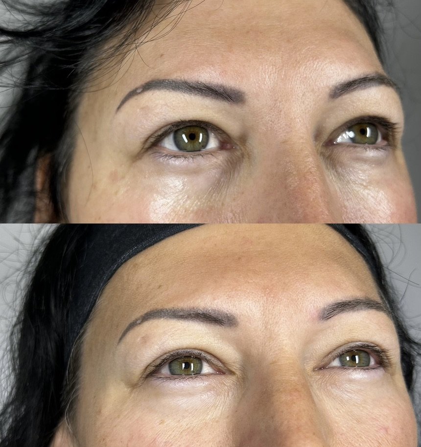 PRP under-eye, 1 session